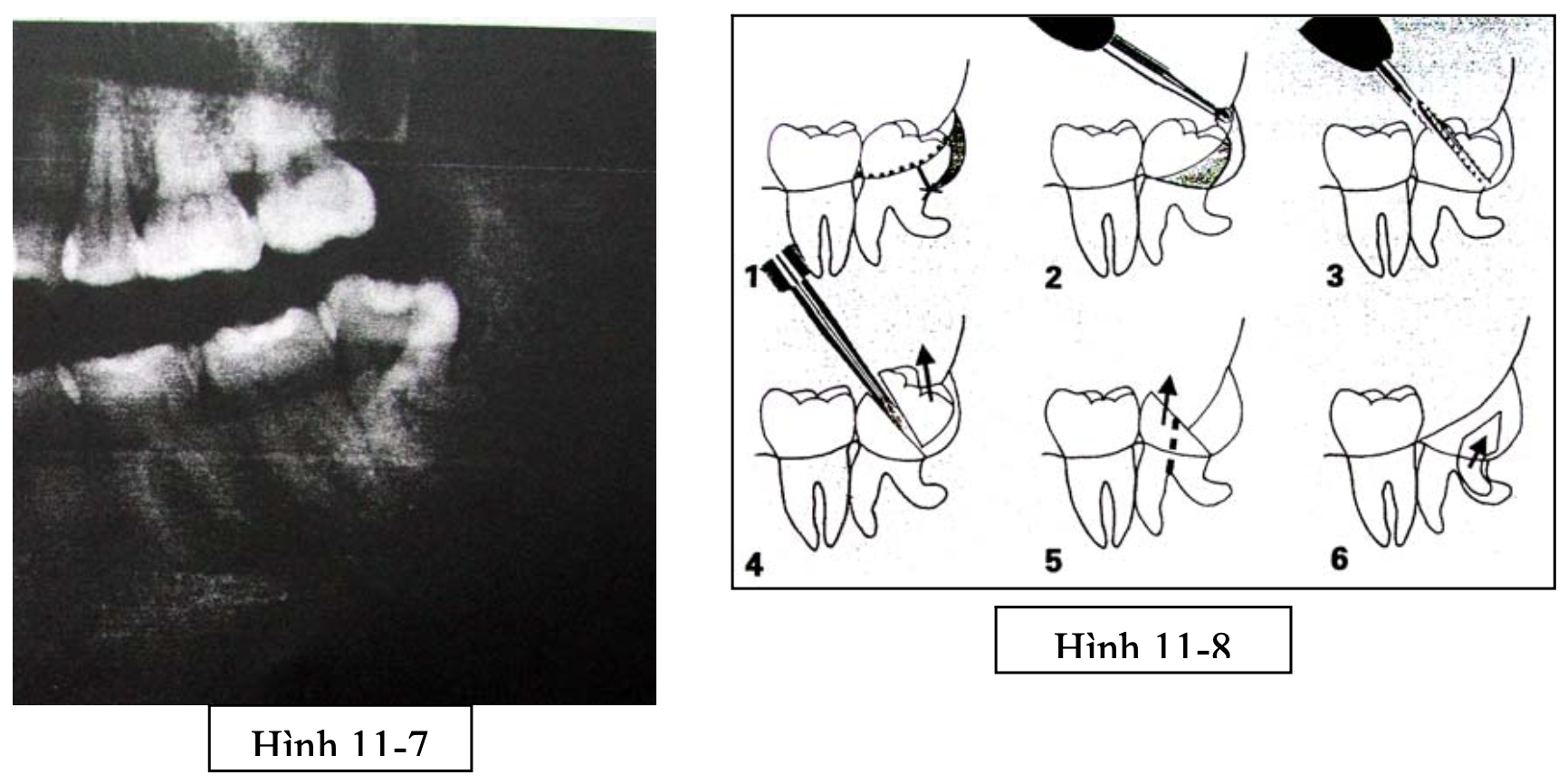 Tiểu phẫu răng khôn mọc nghiêng xa